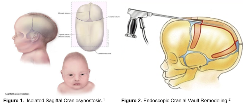 Various angles of an illustrated infant's skull, one of which shows a large rod with a handle being inserted into the top of the skull. 